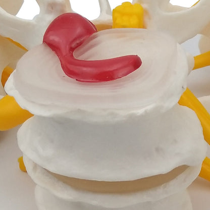 4-Stage Diseased Lumbar Spine Model Medical Teaching Equipment
