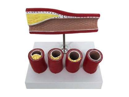 Vascular Anatomy Atheroscosis Teaching Model